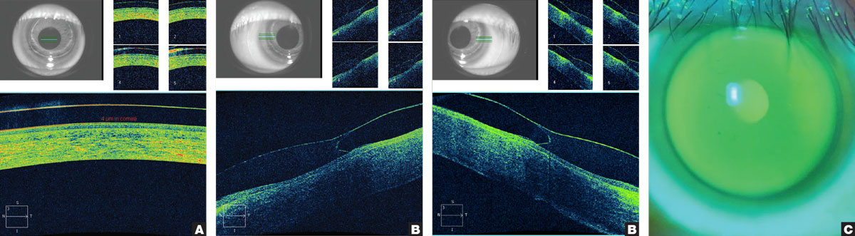 Fig. 4. (A) Apical “lens crash,” or lens bearing, on AS-OCT after one hour of lens settling. (B) Peripheral ILZ bearing nasally (left) and temporally after one hour of lens settling. (C) The sodium fluorescein pattern shows faint central bearing that starkly contrasts with overt lens crash.