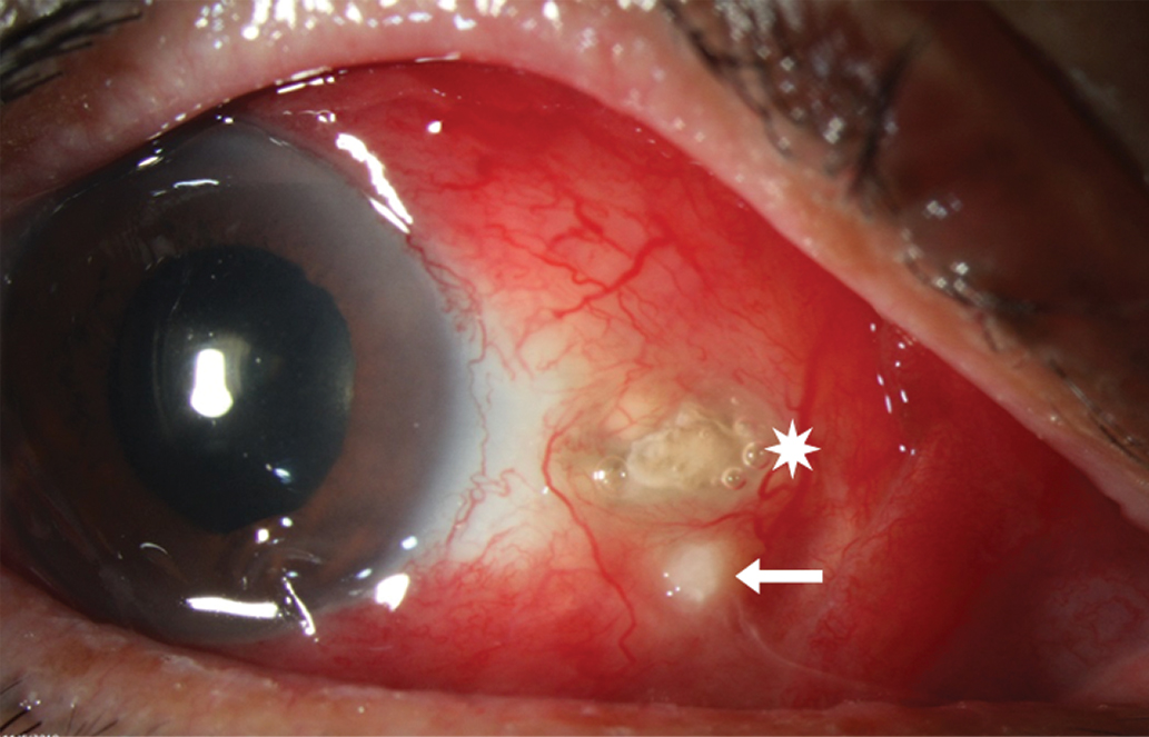 Fig. 1. Intense scleral injection with focal necrosis associated with eroded calcific plaque (white star) and scleral abscess (white arrow).