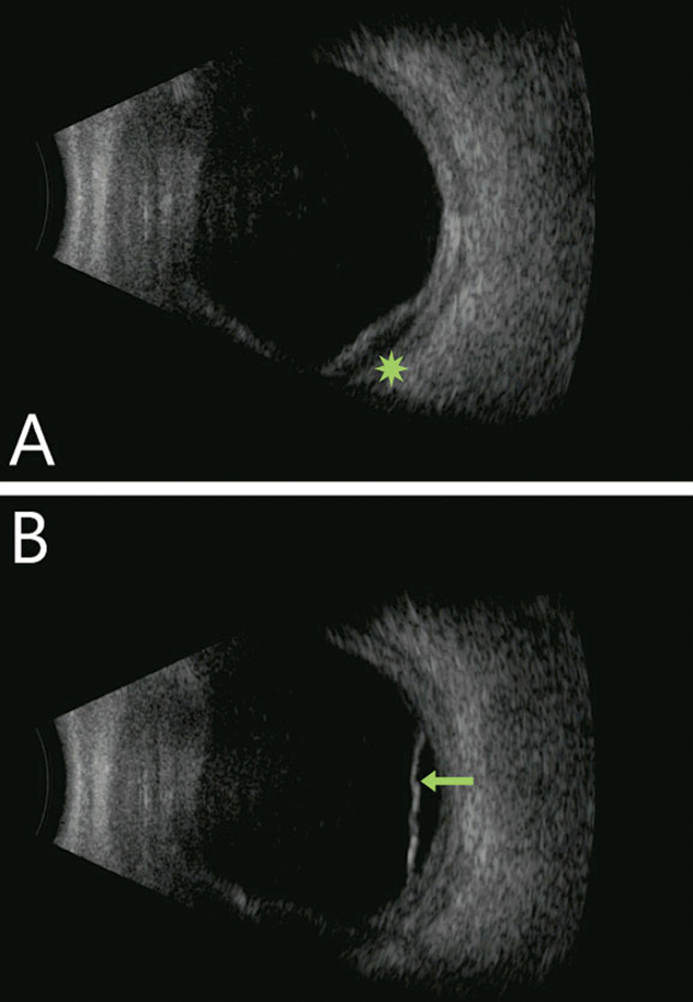 Fig. 2. Diffuse choroidal thickening with focal choroidal detachment (green star) and with shallow serous retinal detachment (green arrow). Notably, the vitreous cavity is quiet in both images.