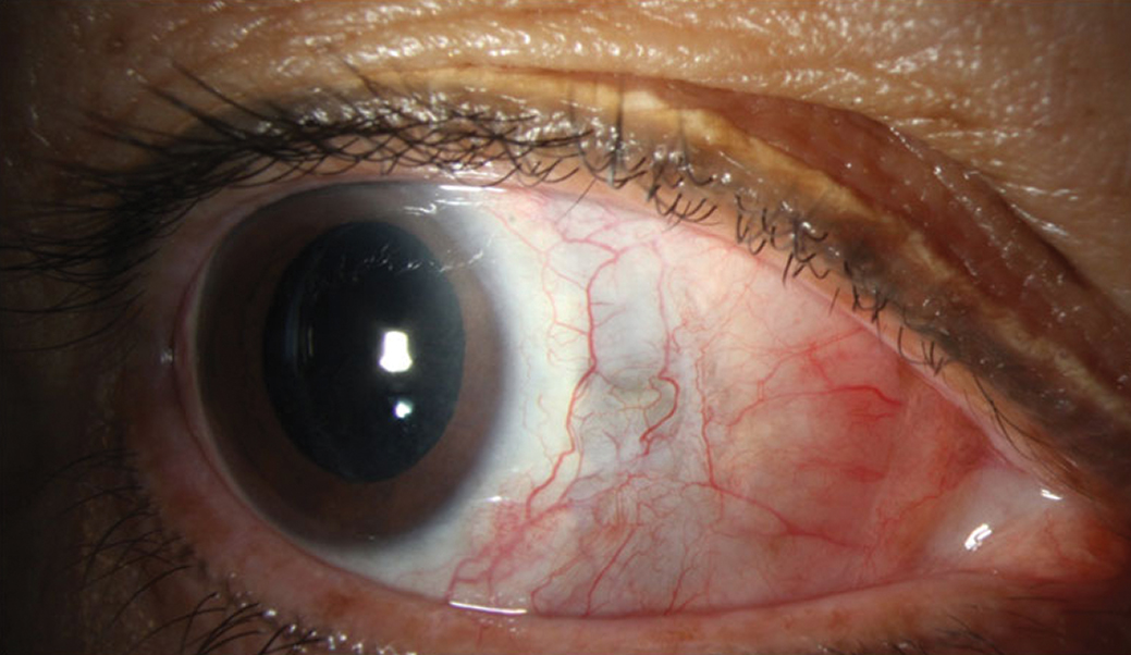 Fig. 3. Improvement in injection and resolution of abscess. Residual scleral thinning is evident by the bluish hue.