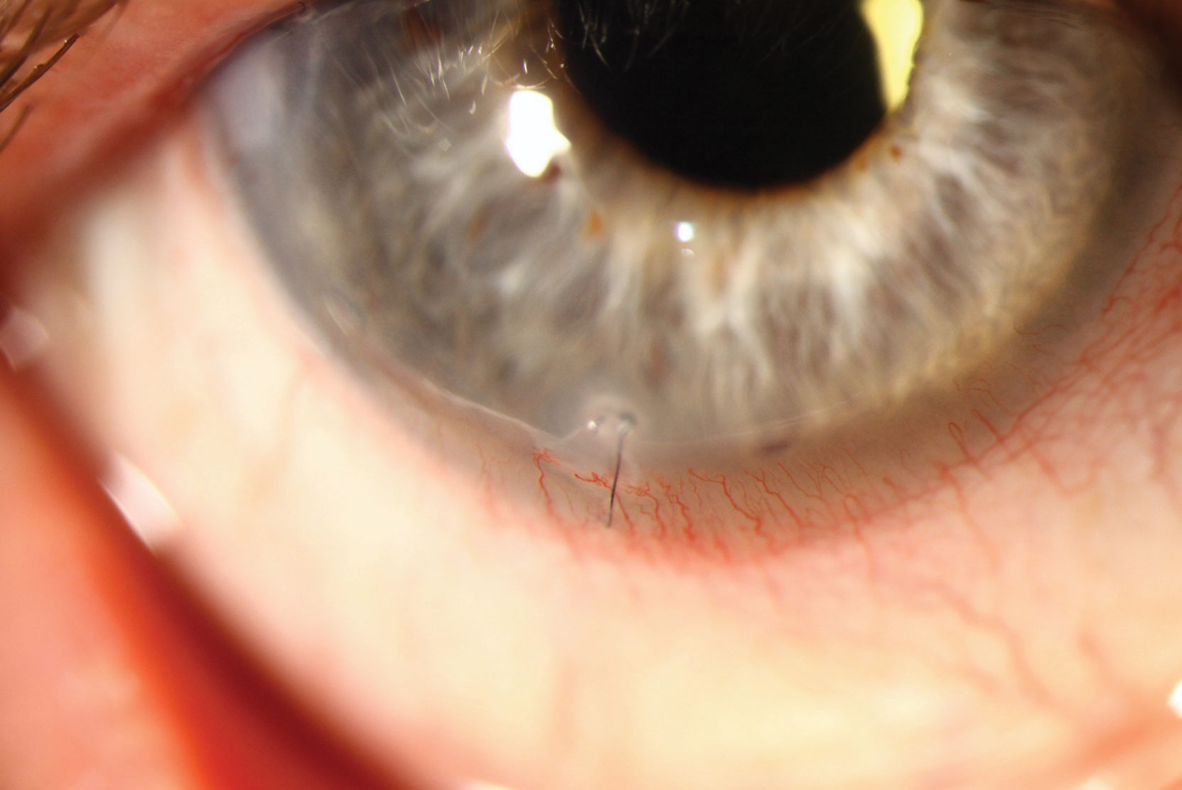 Monitor corneal sutures closely, as they provide a vector for infection.