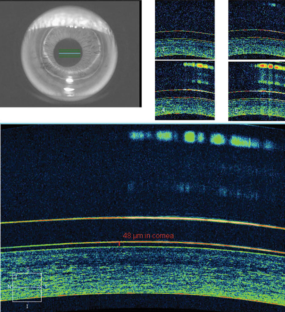 Fig. 6. AS-OCT demonstrates ideal tear film alignment over the central cornea with good lens centration after a few hours of wear.