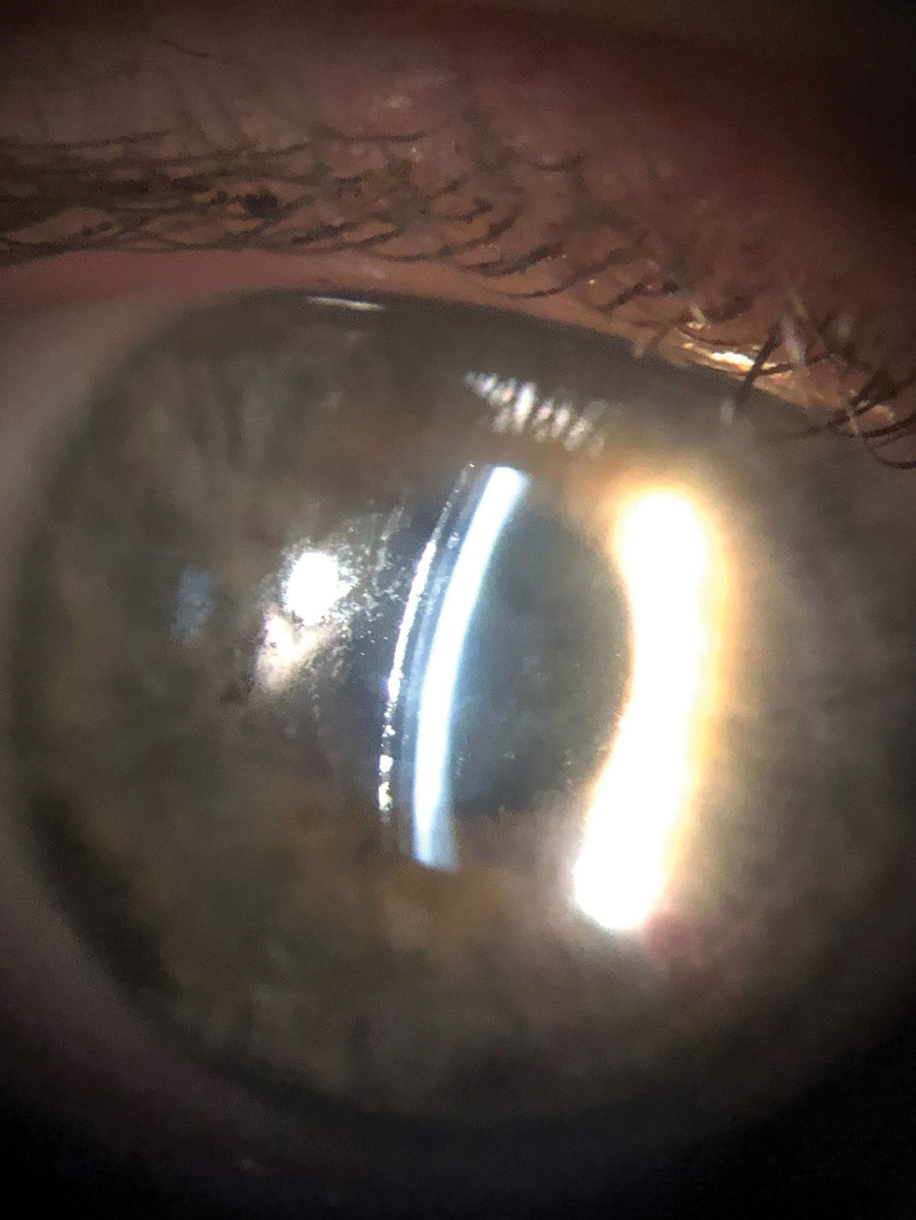 This poorly wetting scleral surface could benefit from adding a soft lens.