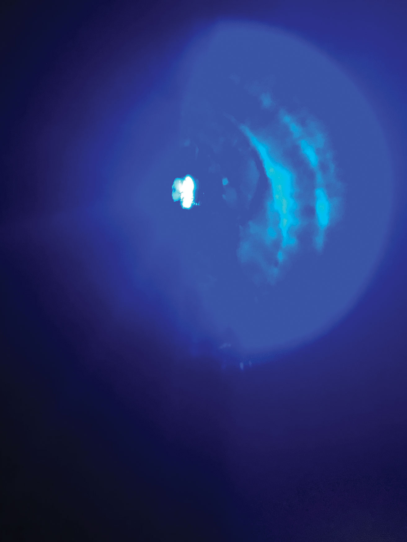 Corneal molding and staining with a tight-fitting hybrid lens.
