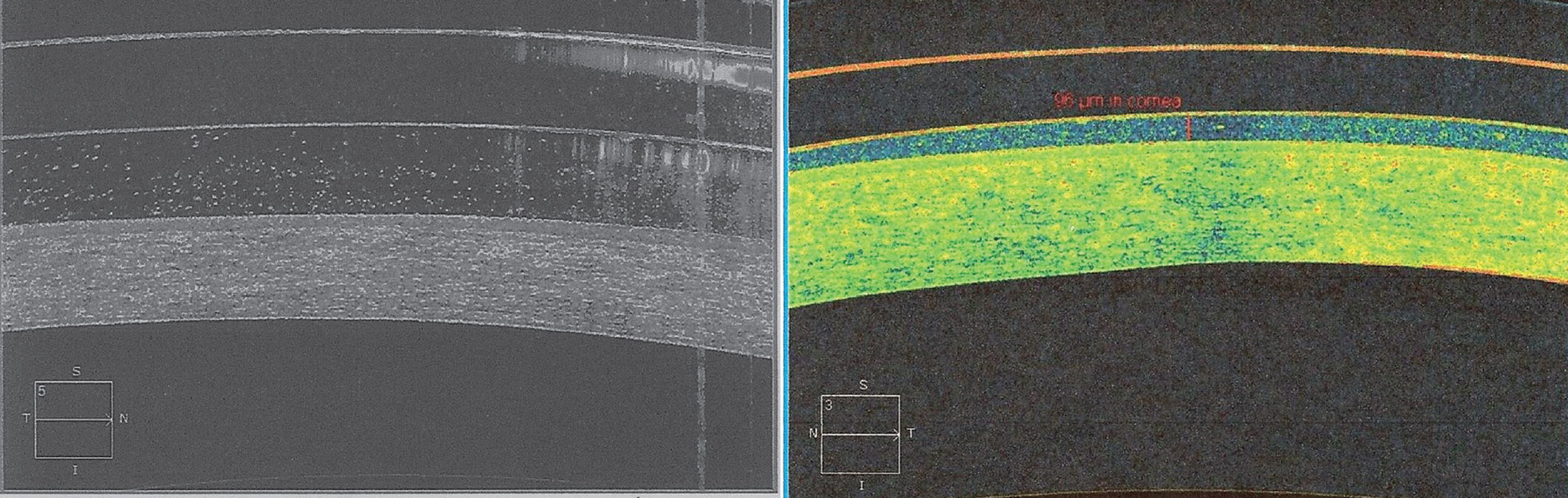 At left, OCT imaging of a scleral contact lens shows debris in the post-lens tear layer. Refitting this patient into a hybrid contact lens resulted in much less debris in the post-lens tear layer.