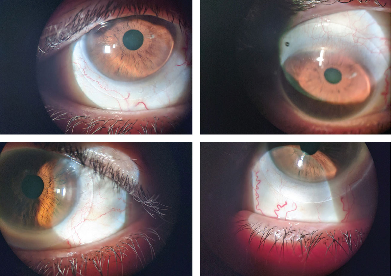 The patient in case 1 was fit with scleral lenses (OD on top).