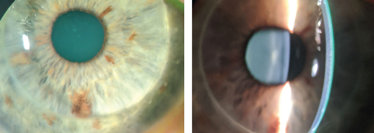 The patient in case 3 had a PKP in his right eye (left). An optic section highlights the graft-host junction of the PKP.