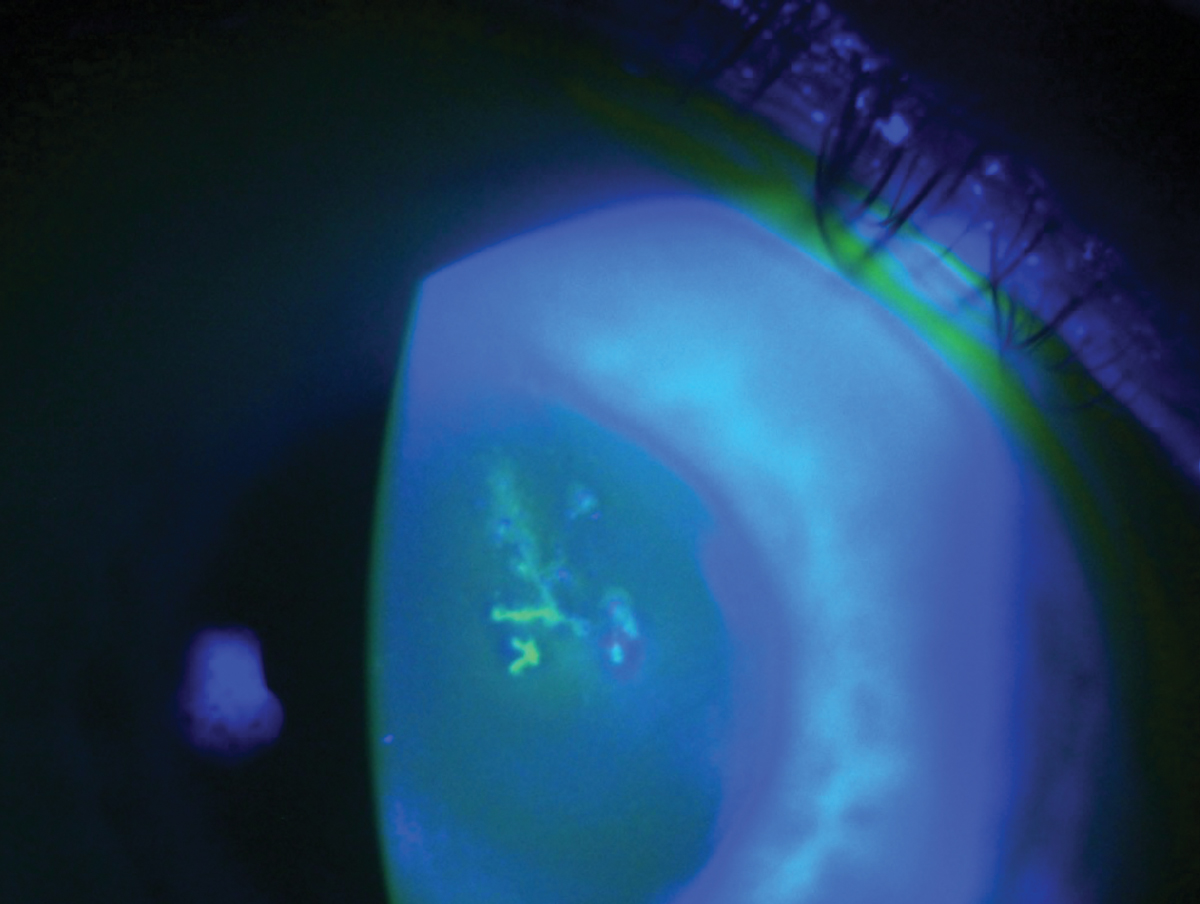 HSV epithelial keratitis is characterized by a dendrite lesion with terminal bulbs. 