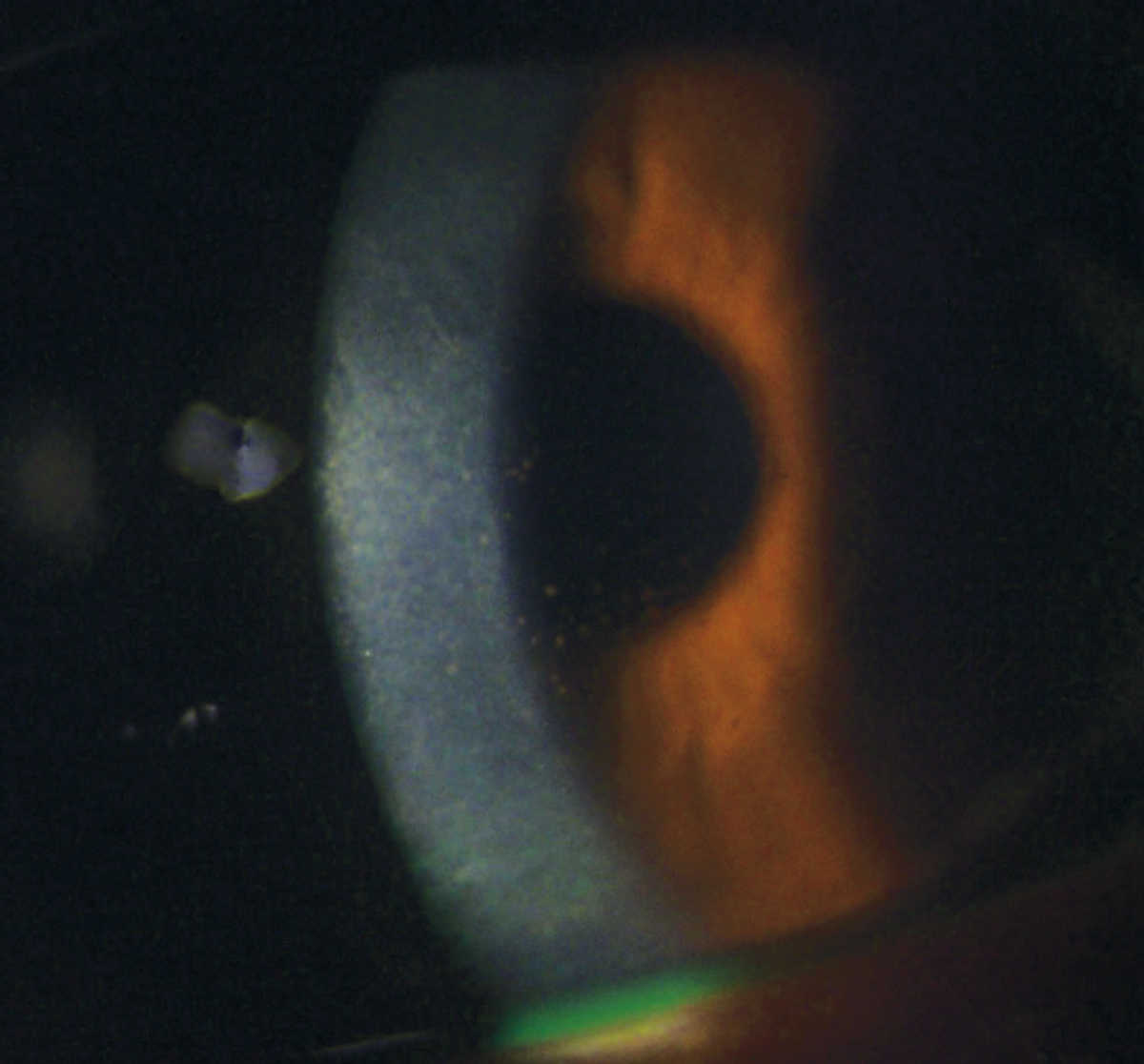 HSV endothelial keratitis is unique because it can occur with or without prior HSVK clinical manifestation. 