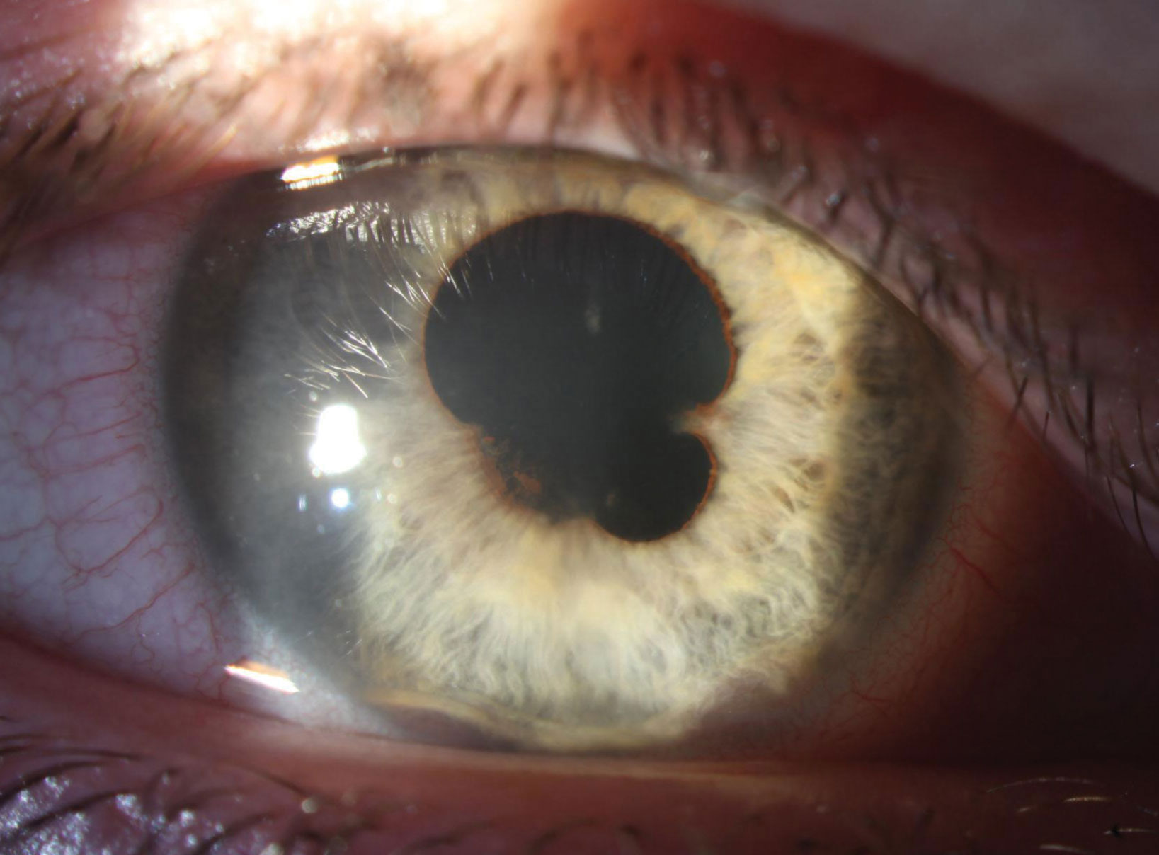 Broad and extensive posterior synechia are present in the right eye at presentation. Substantial anterior synechia are also apparent at 5 o’clock and 7 o’clock.