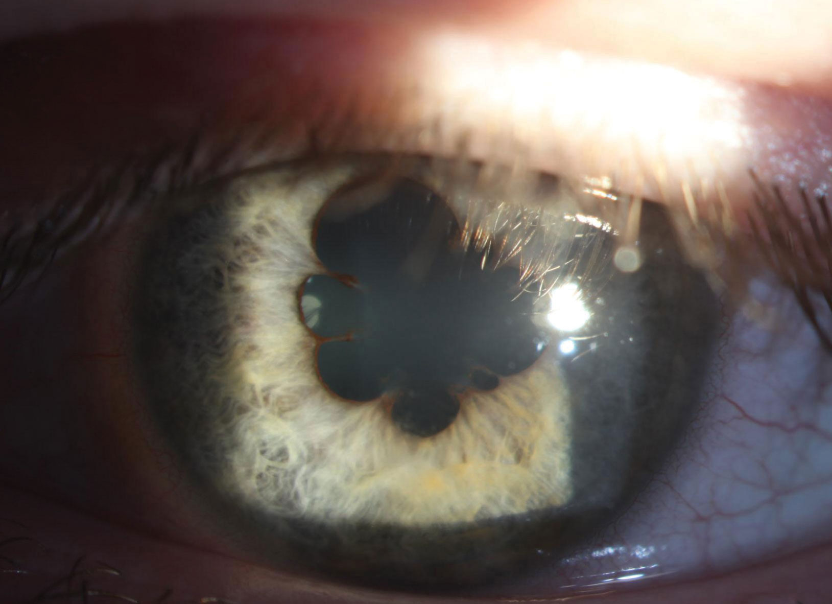 In the left eye, 360° of marked posterior synechiae can be seen at presentation.