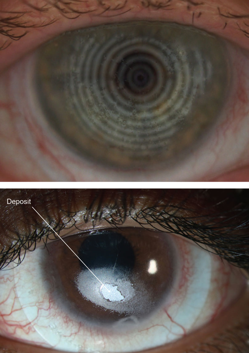 Figs. 2 and 3. Deposits (distorted spots) might appear on a compromised scleral lens surface. Photos: Maria Walker, OD, and Gloria B. Chiu, OD. 
