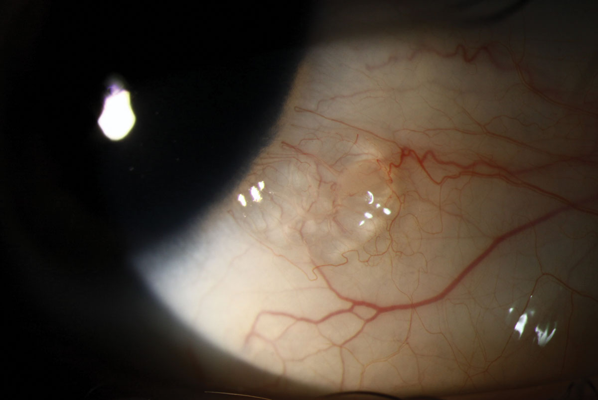 Conjunctival lymphangiectasis can present as a bubble on the bulbar conjunctiva that often has a cystic appearance and may be clear or yellow.