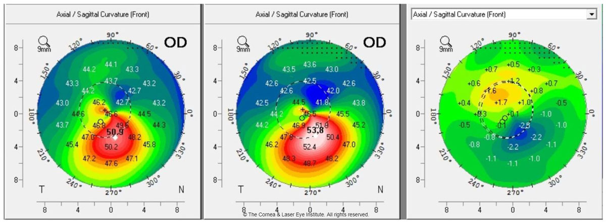 Fig. 1a. These axial curvature topography maps display differences (right) in pre-op curvature (center) to one-year post-op curvature (left). This cornea shows flattening of the corneal apex, consistent with the dioptric change reported in the literature one year after standard CXL.