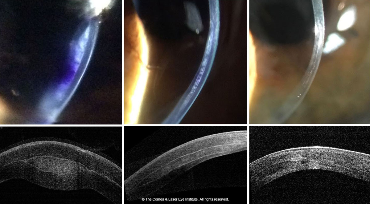 Fig. 4. These images show the optic section and corneal OCT of post-op allograft corneal tissue implantation for keratoconus, immediately post-op (left), one month post-op (middle) and 18 months post-op (right).