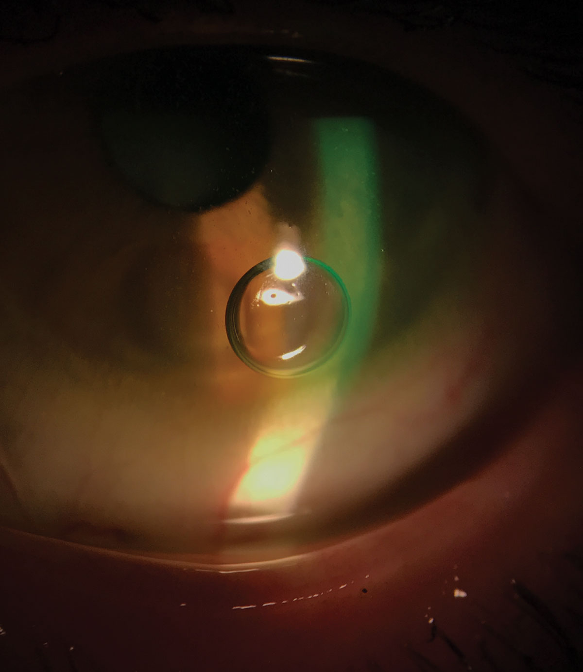 Fig. 1. One common problem associated with scleral lens application is application bubbles. Photo: Melissa Barnett, OD.