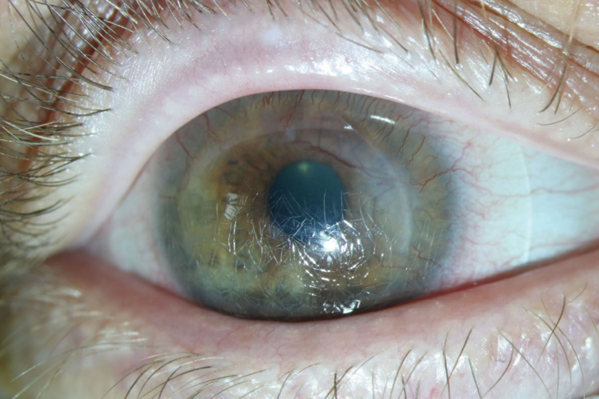 Fig. 4. Over time, a scleral lens might get severely scratched and damaged. Photo: Gloria B Chiu, OD. 