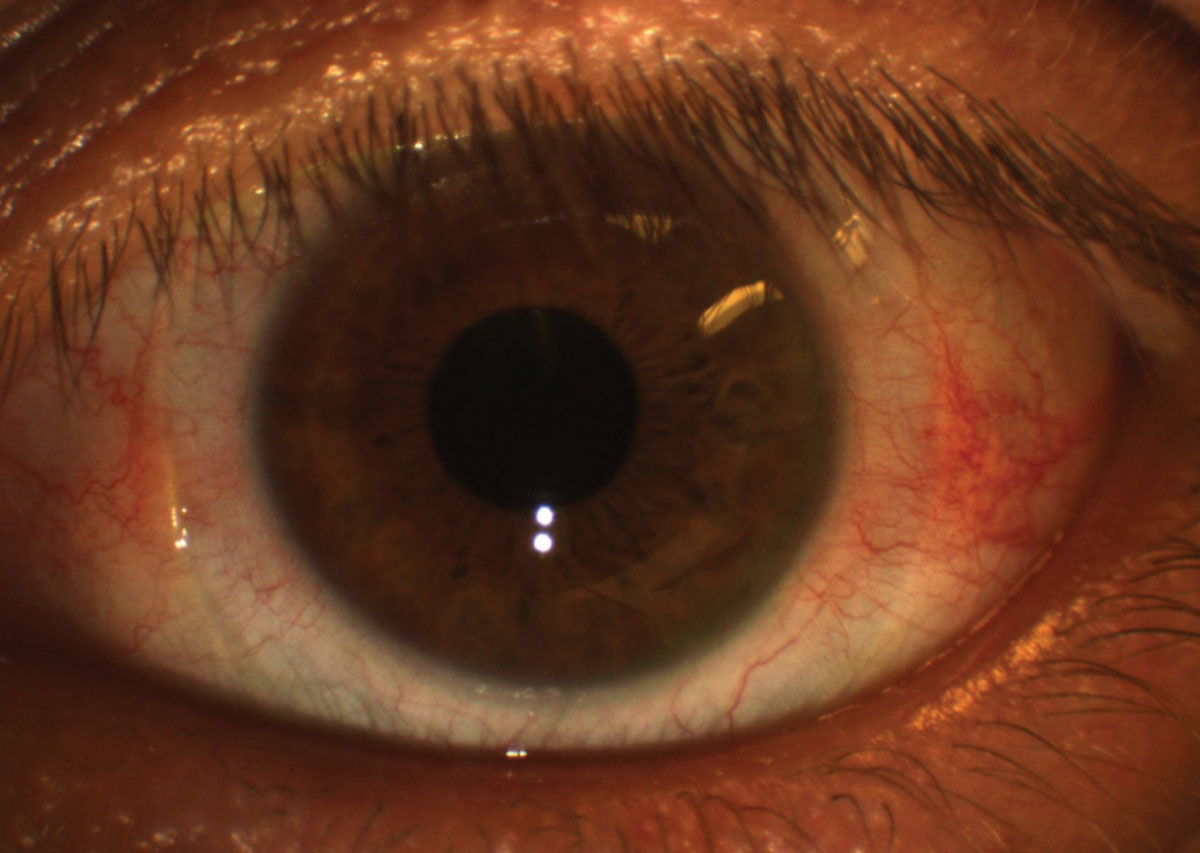 Fig. 9. Conjunctival redness (3 o’clock and 9 o’clock regions) after scleral lens removal might be due to a lens that is too tight in the periphery. Photo: Maria Walker, OD. 