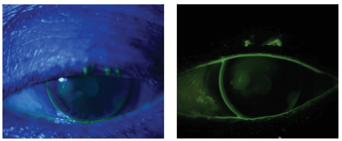 The same lens is viewed with blue light (left) and then with a wratten filter (right). The filter highlights a small area of pooling with dimple veiling over a corneal scar in the temporal cornea.