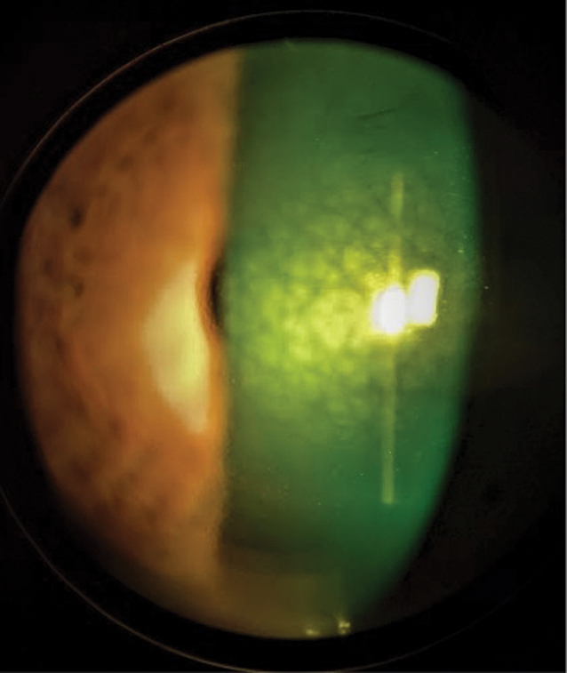 Fig. 1. This central mosaic dystrophy pattern is associated with megalocornea.