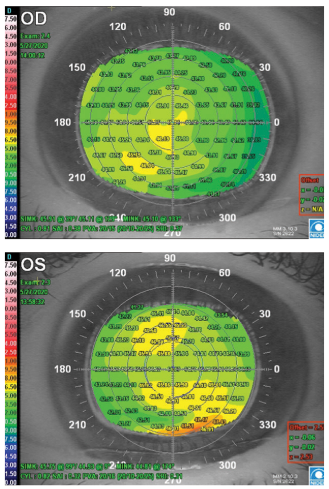 Fig. 3. These placido disc topographies of megalocornea have a generally uniform appearance OD (top) and mild peripheral inferior steepening OS (bottom). 