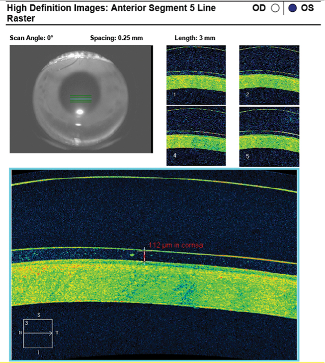 Fig. 7. AS-OCT of the 4300µm/42/48/8.8mm/17.5mm scleral lens shows a very high center thickness and apical tear film thickness of 114µm that is thin but acceptable after 60 minutes of lens settling.