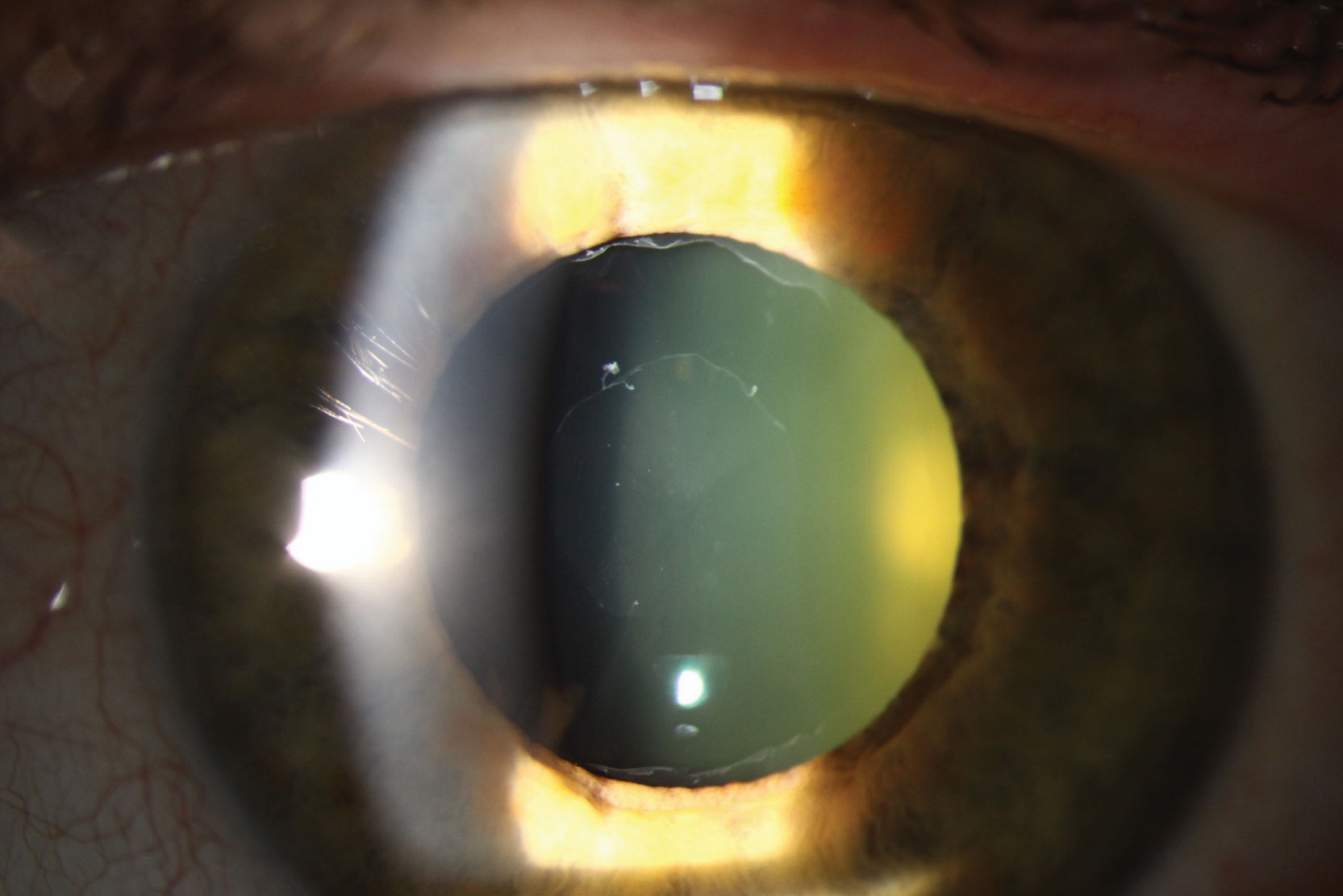 This patient was diagnosed with PXF, a risk factor for glaucoma.