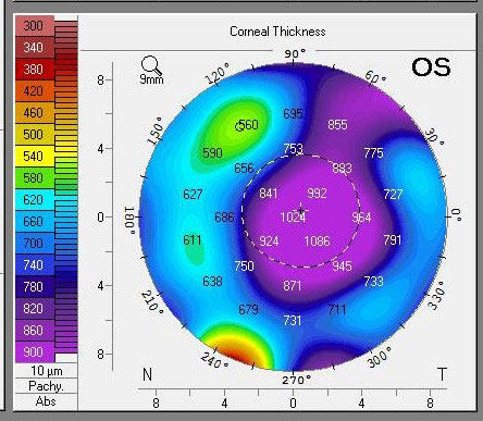 Pachymetry following a DSO supported by Rhopressa shows profound central edema.