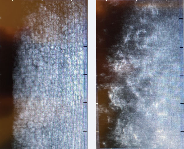 Non-contact specular microscopy of a normal corneal endothelium (left) and of a patient with Fuchs’ dystrophy (right).
