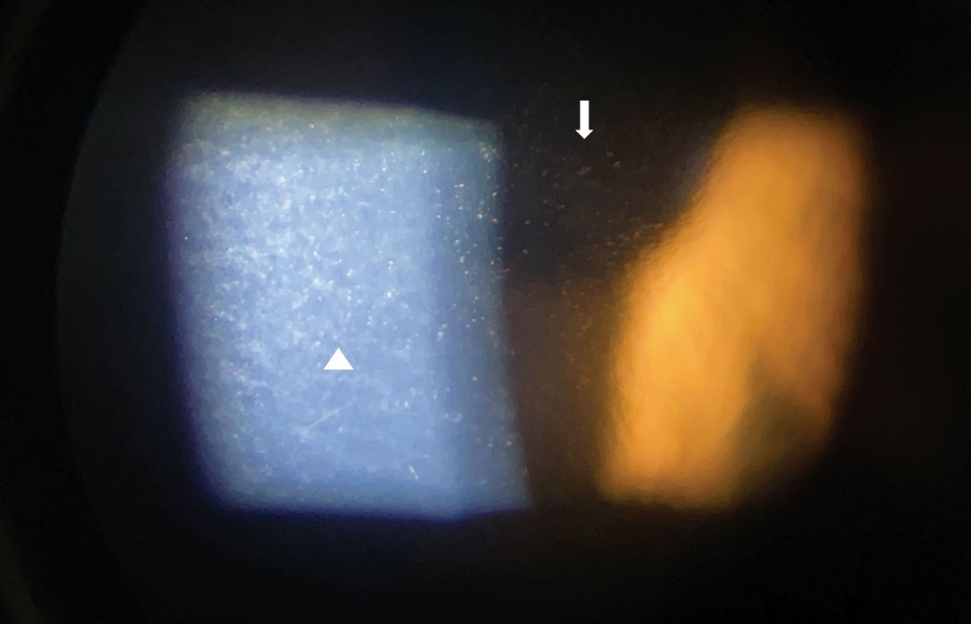 Slit lamp imaging through an iPhone X of pigmented corneal guttata in a patient with Fuchs’ endothelial dystrophy with lesions viewed in high magnification in direct (triangle) and indirect (arrow) illumination.