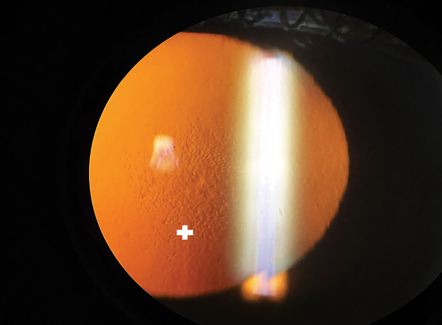 Slit lamp imaging using an iPhone X of central guttata in a patient with Fuchs’ endothelial dystrophy with lesions viewed in retroillumination (plus sign).