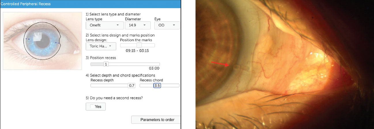 Blanchard’s CPR tool helps visualize the lens and can be used to populate lens parameters (left). At right, the ordered lens displays toric markings, which are important to note prior to making any haptic changes.