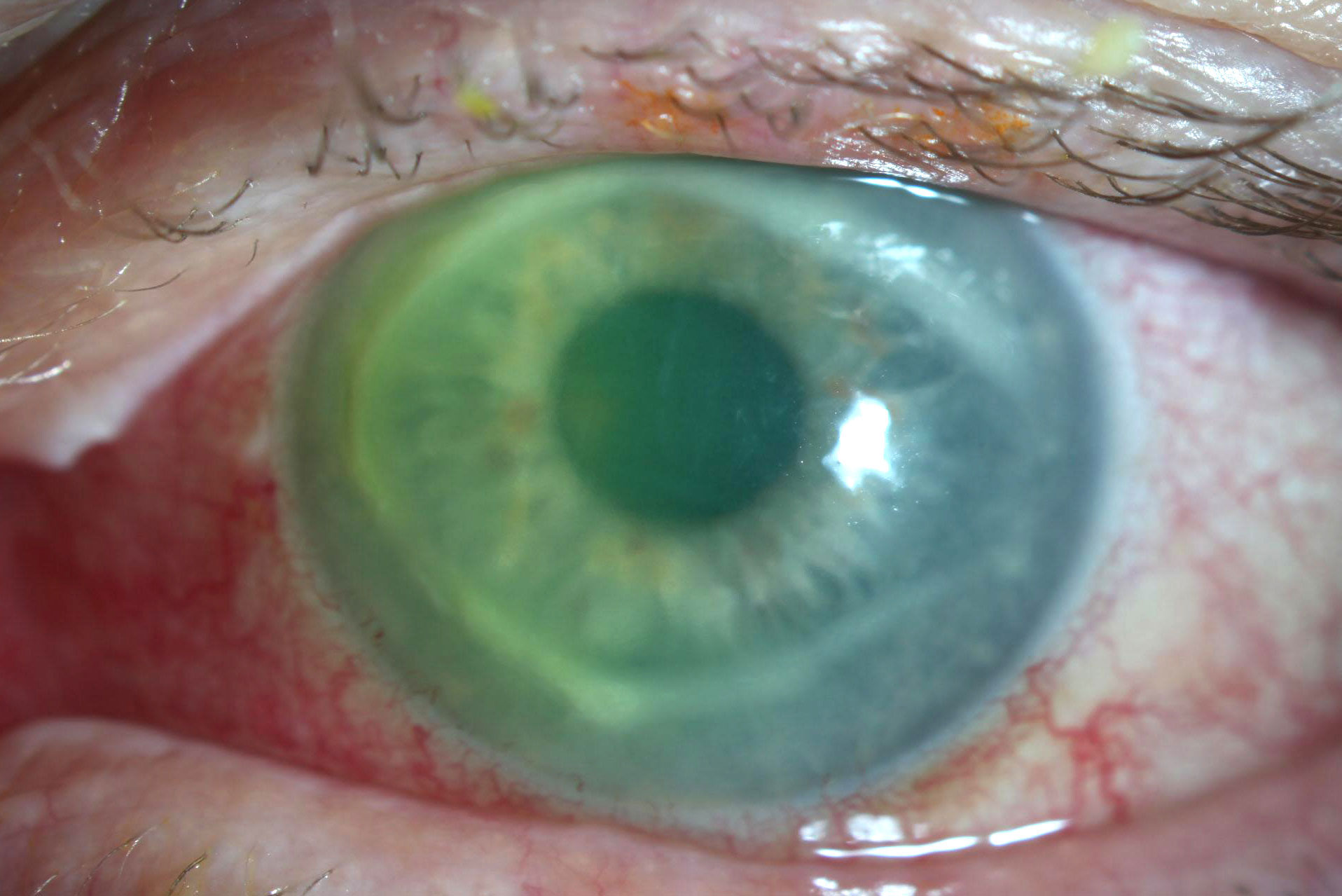The patient’s eye at presentation shows 2+ to 3+ injection, a dense apical ring and central stromal edema.