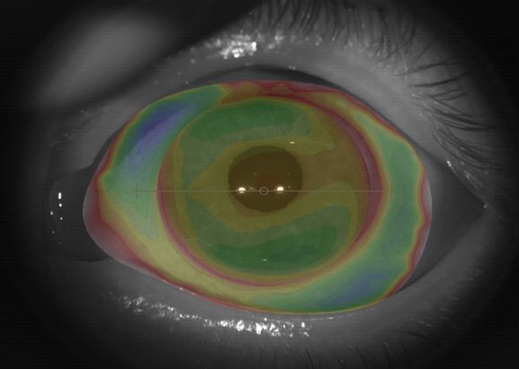 Fig 1. This profilometry image helped design our patient’s scleral lens.
