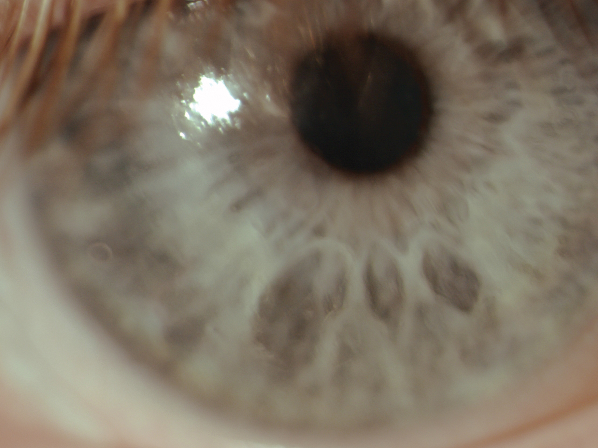 Fig. 2. This front surface non-wetting of the scleral lens was caused by lack of adherence to solutions regimen.