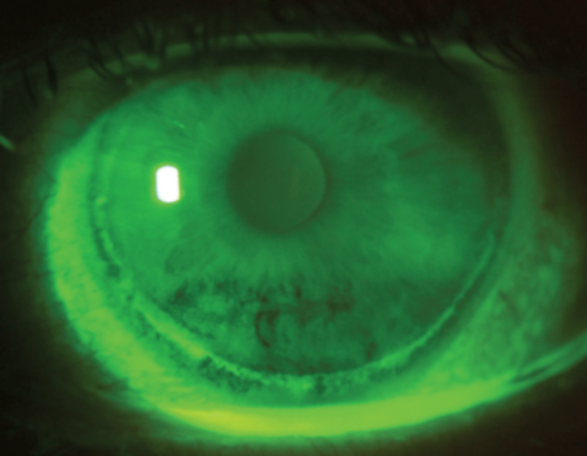 Even though the introduction of silicone hydrogel lenses achieved notable benefits for eye health, the material is still susceptible to complications, especially when worn beyond the recommended wear schedule, and in this case of circumlimbal epithelial splitting from extended wear.