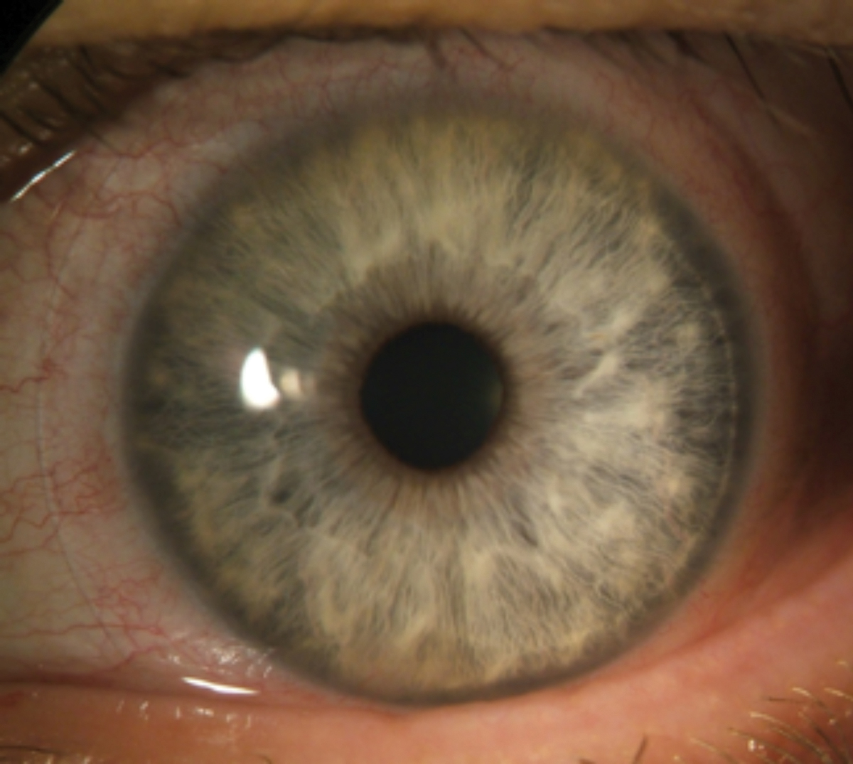 Contact lens–induced acute red eye response (CLARE) from extended wear SiHy lenses.