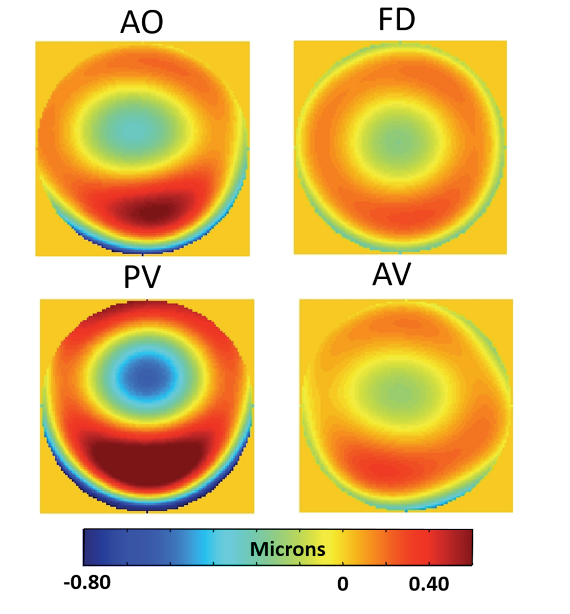 Higher-order wavefront error maps (6mm pupil) of four different soft toric contact lenses (all -3.00D nominally labeled power) as measured with an aberometer off of the eye in a saline-filled wet cell. Lower-order aberrations, including sphere and astigmatism, have been zeroed to show only the higher-order aberrations.