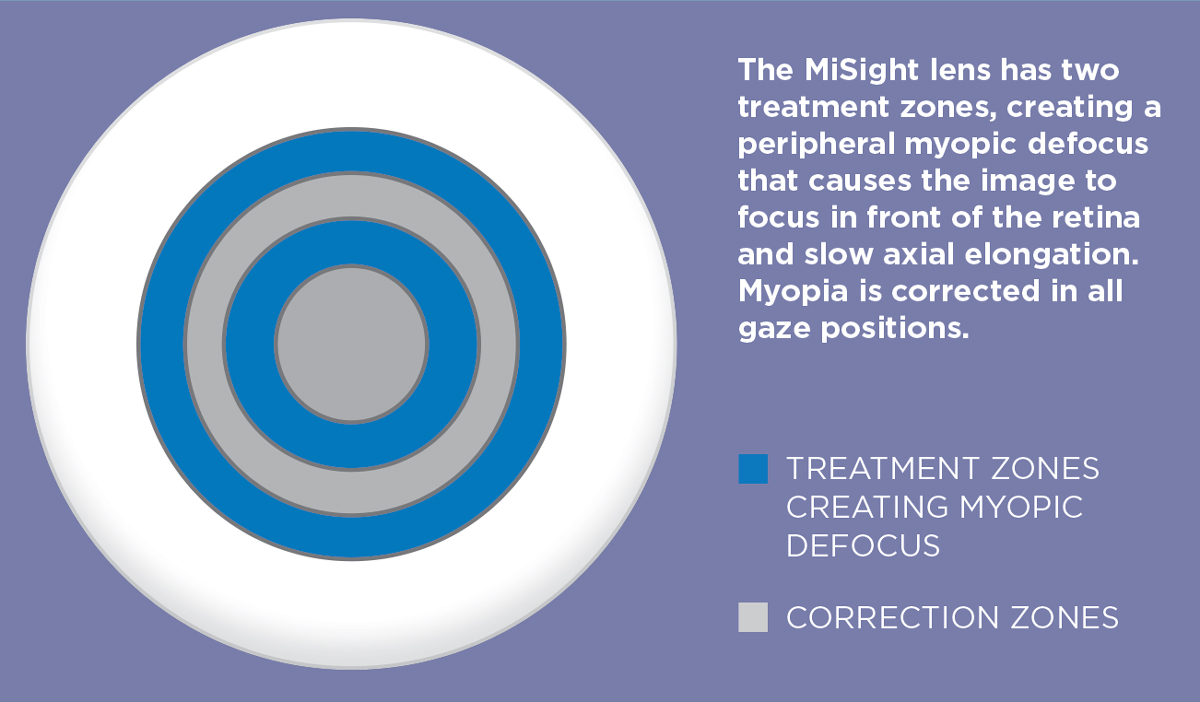 The MiSight Lens has two treatment zones, creating a peripheral myopic defocus that causes the image to focus in front of the retina and slow axial elongation. Myopia is corrected in all gaze positions. 