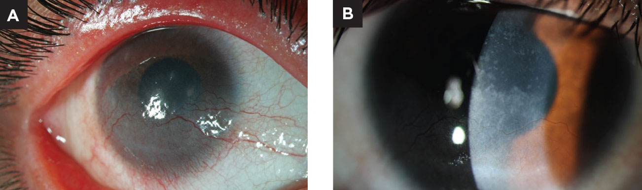 This young patient presented with superficial corneal NV due to chronic blepharitis. She was treated with lid hygiene, oral antibiotics and topical corticosteroids before transitioning to maintenance therapy of cyclosporine, compounded topical doxycycline and scleral contact lens wear. Note the improvement in the superficial vascularization.