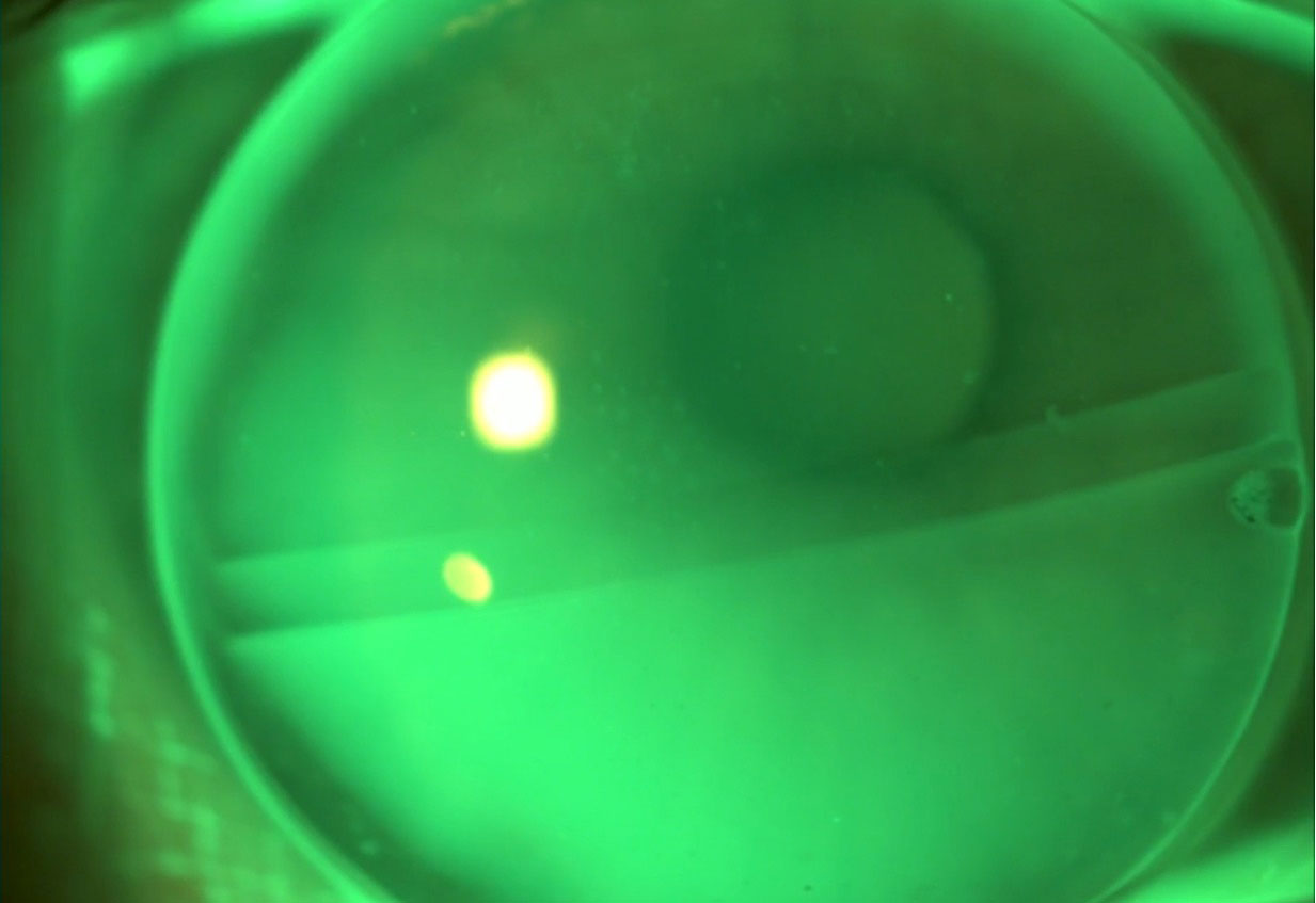 Anterior segment image of a fluorescein pattern of a trifocal GP contact lens.