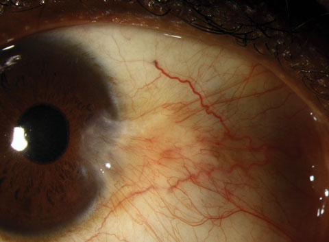 More than a third of pterygium recurrences develop after the first year.
