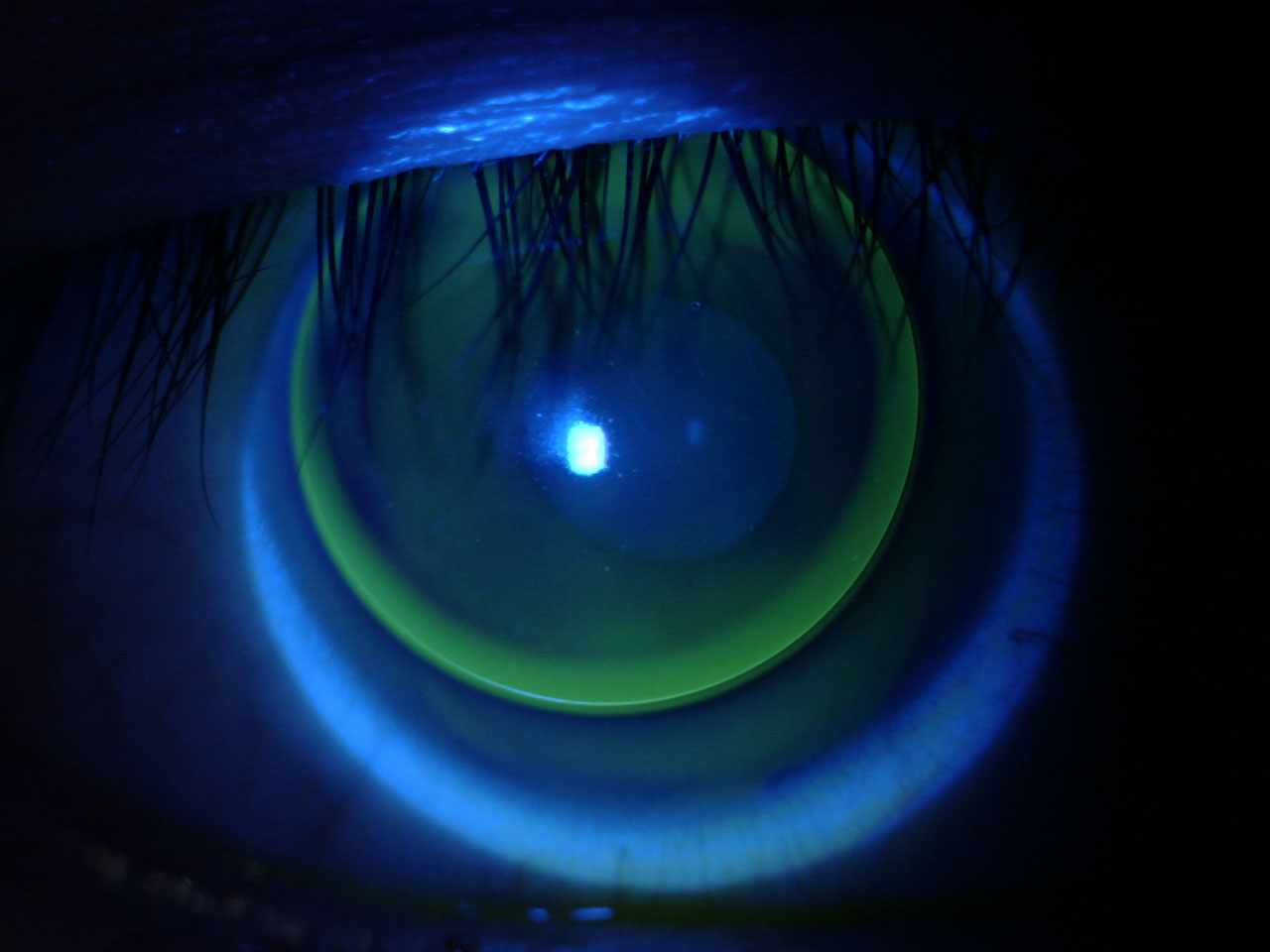 Fig 1. Lid-attached corneal GP lens fit on a patient with myopic astigmatism.