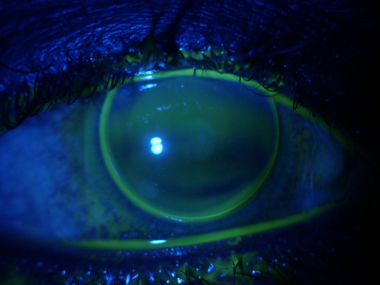 Fig 2. Corneal GP fit on a myopic patient with neovascularization due to previous overwear of a hydrogel soft lens.