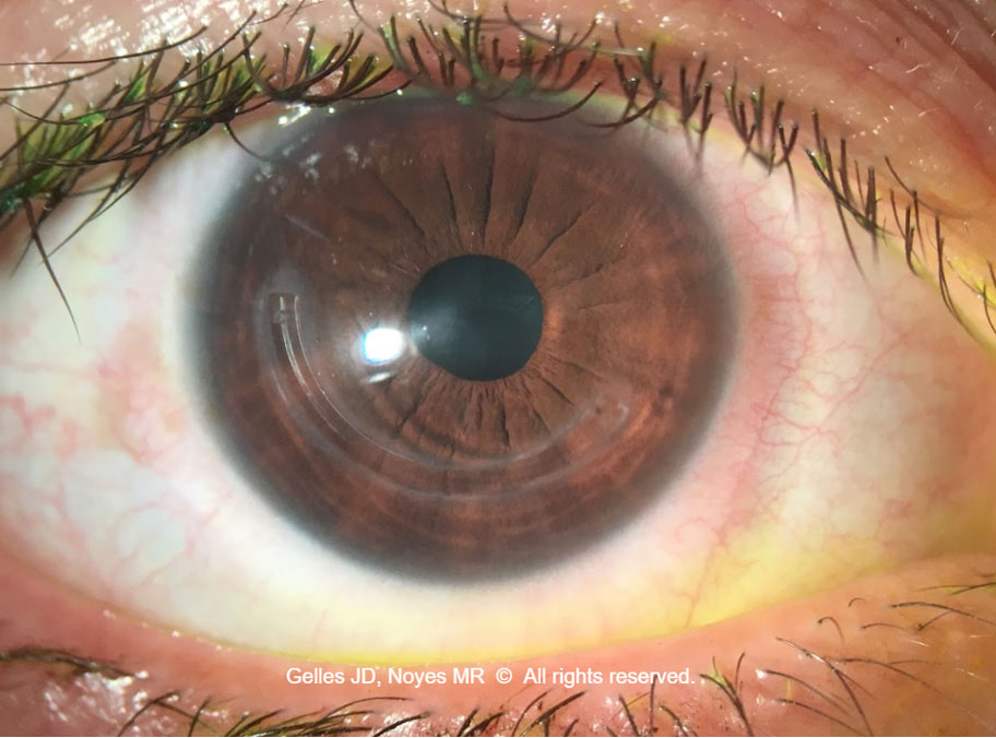 Note the deep conjunctival impression on the nasal side of the scleral lens post-removal, with corresponding grade two nasal conjunctival rebound hyperemia. On the temporal side, the conjunctival impression and rebound injection signs are less impressive and the hyperemia is more focal. To improve the landing zone alignment, incorporate a quadrant-specific landing zone flattening the nasal quadrant more than the temporal, increase the landing zone width to spread the lens pressure more evenly and consider adding a focal peripheral elevation to the temporal side at the location of the hyperemia.