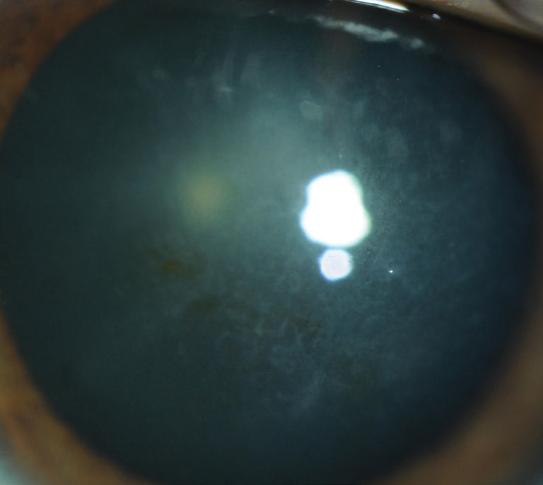 Signs of Reis-Bucklers corneal dystrophy include confluent geographic-like opacities at Bowman’s layer that become less discrete.