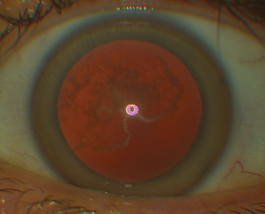 Schnyder corneal dystrophy as seen on retroillumination.