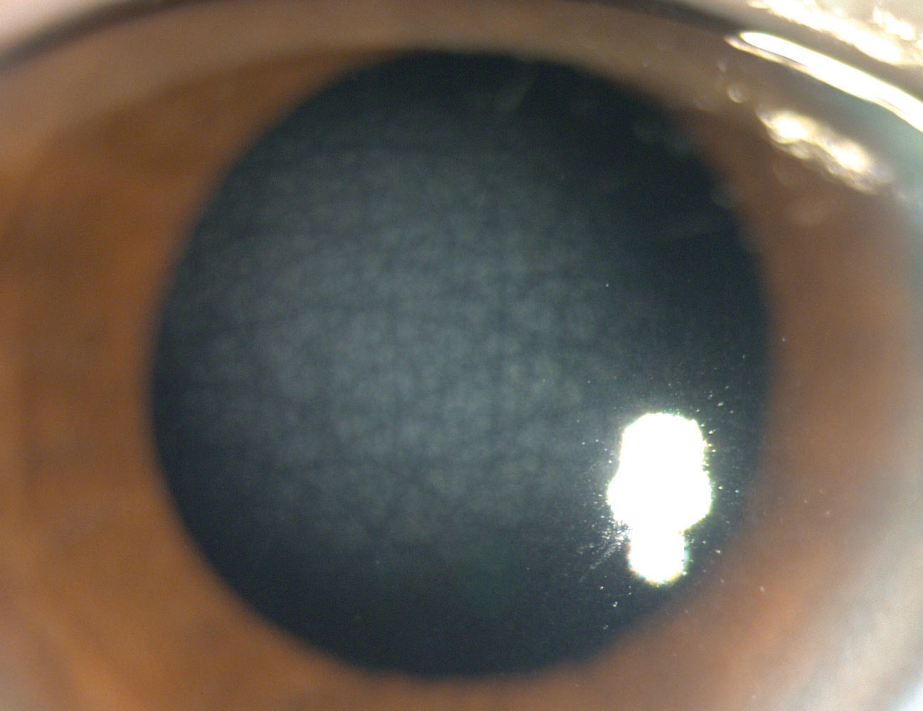 The appearance of central cloudy dystrophy resembles that of crocodile shagreen within the anterior central cornea.
