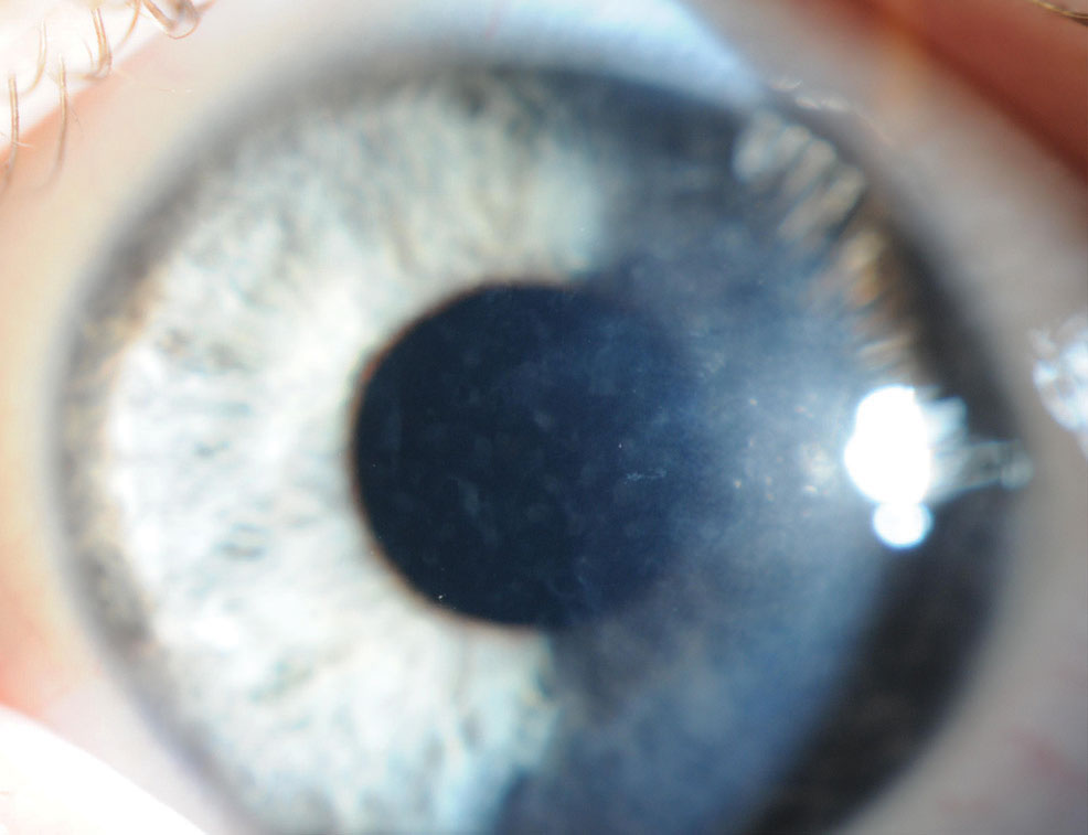Signs of posterior amorphous corneal dystrophy start out with asymmetric gray opacities of Descemet’s membrane and endothelium.
