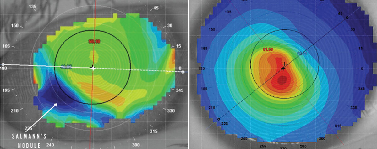 This patient has a midperipheral Salzmann’s nodule, as indicated by the white arrow (left). Central corneal steepening is a classic sign of keratoconus (right). 
